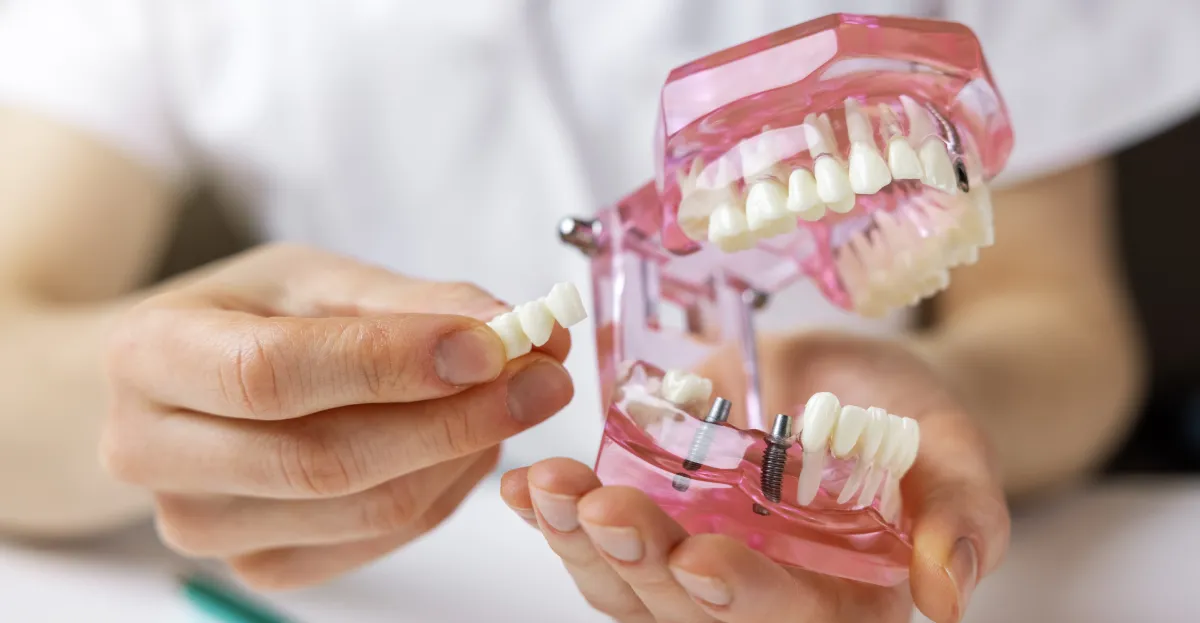 Dental Implants in Sacramento: What You Can Expect